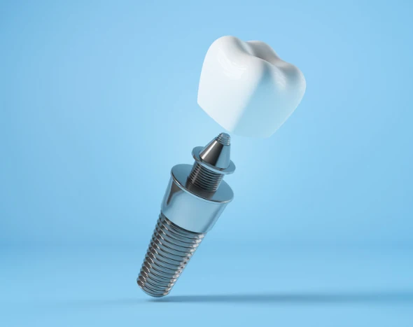 dental implants